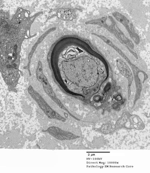 5C2C Paraprotein, AxDegen, Demyel (Case 5) EM 019 - Copy