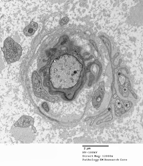 5C3 Paraprotein, AxDegen, Demyel (Case 5) EM 004 - Copy