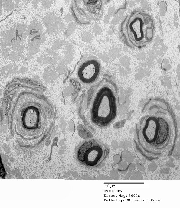 5C4 Paraprotein, AxDegen, Demyel (Case 5) EM 024 - Copy
