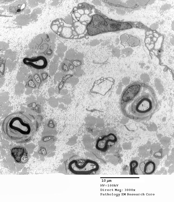 5C5 Paraprotein, AxDegen, Demyel (Case 5) EM 025 - Copy