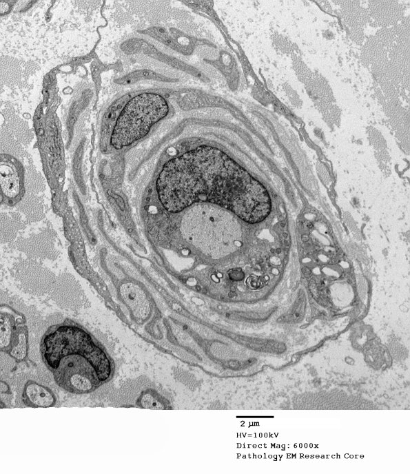 5C7B Paraprotein, AxDegen, Demyel, (Case 5) EM 028 - Copy