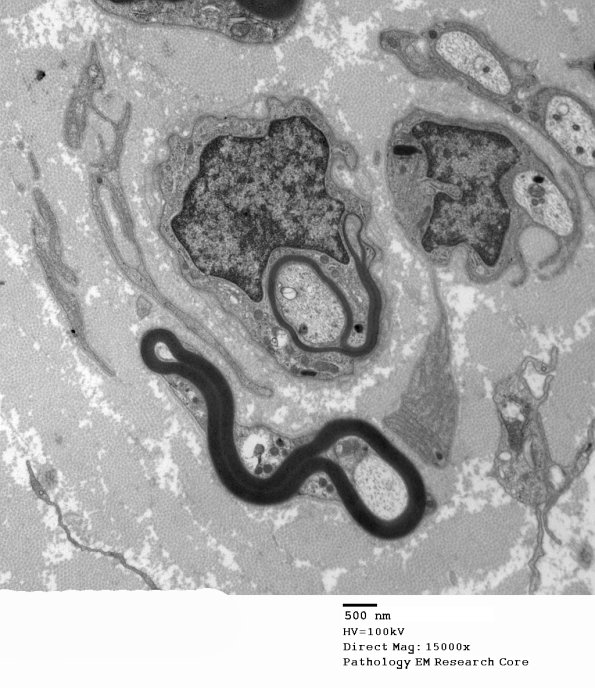 5C8 Paraprotein, AxDegen, Demyel, (Case 5) EM 036 - Copy