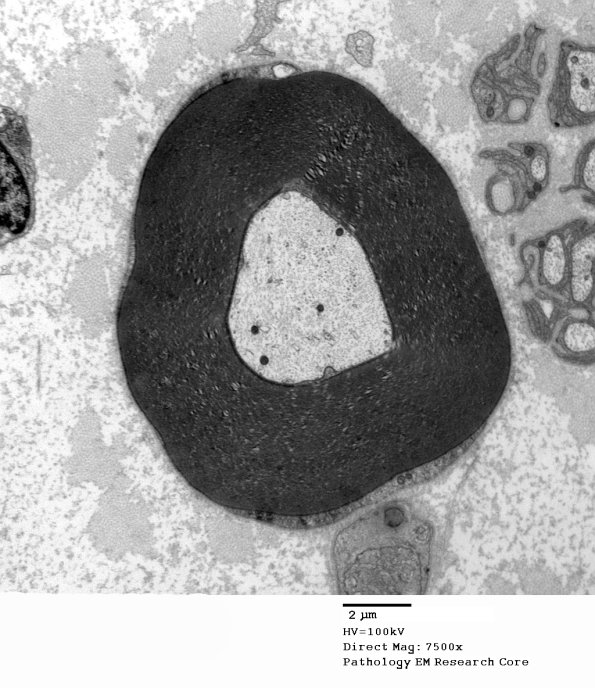 5C9 Paraprotein, AxDegen, Demyel, (Case 5) EM 064 - Copy