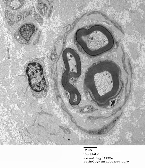 5D1 Paraprotein, AxDegen, Demyel, (Case 5) EM 2 - Copy