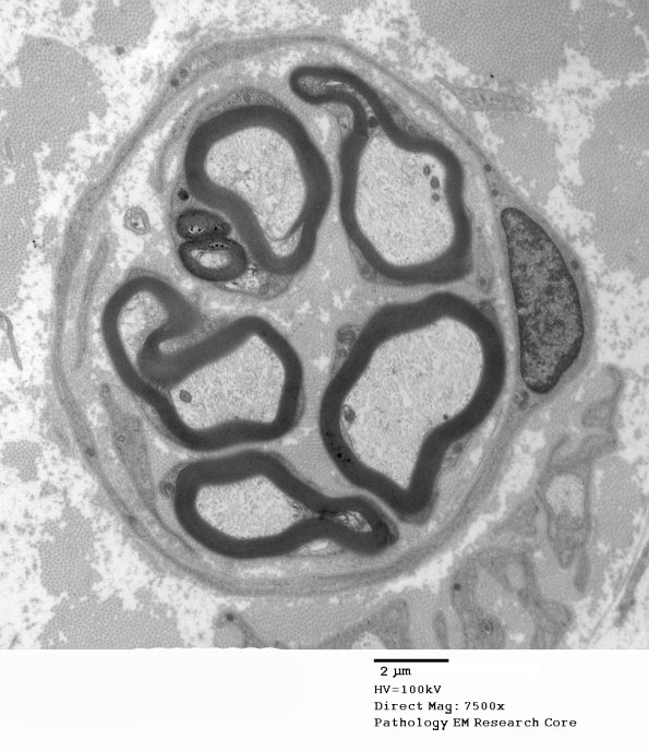 5D2 Paraprotein, AxDegen, Demyel, (Case 5) EM034 - Copy