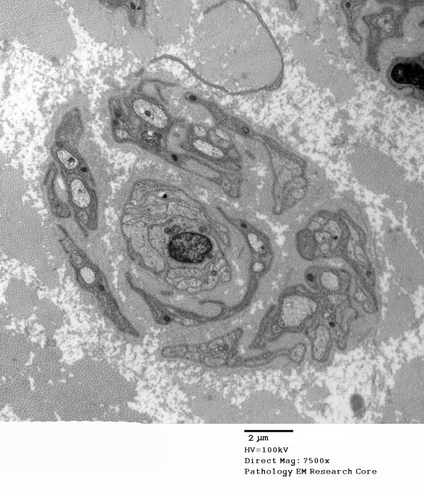 5D3 Paraprotein, AxDegen, Demyel, (Case 5) EM 038 - Copy