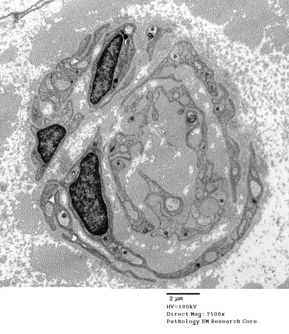 5D4 Paraprotein, AxDegen, Demyel, (Case 5) EM 029 - Copy