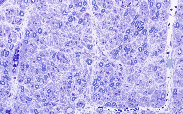 6A2 Anti-MAG Neuropathy (Case 6) Plastic 40X