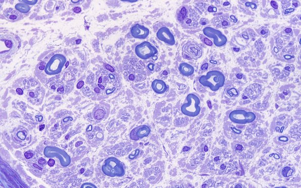 6A3 Anti-MAG Neuropathy (Case 6) Plastic 100X 1