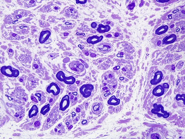 6A4 Anti-MAG Neuropathy (Case 6) Plastic 1.jpg