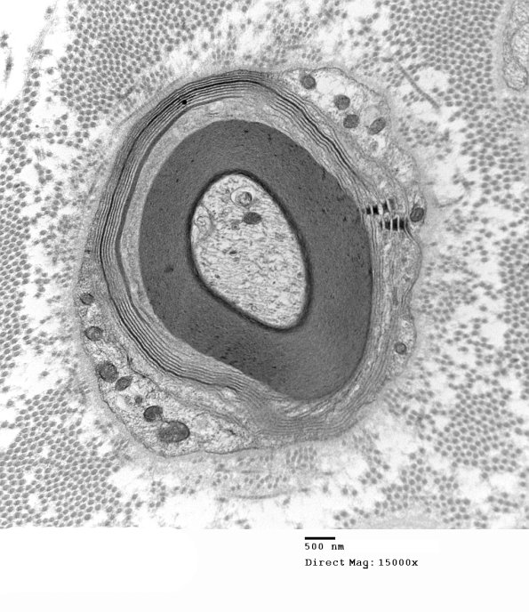 6B1A Anti-MAG NP (Case 6) EM 014 - Copy