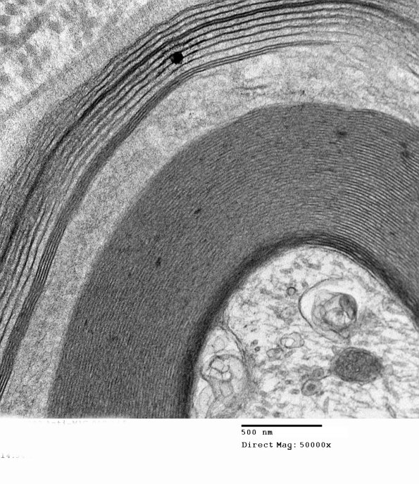 6B1B Anti-MAG (Case 6) EM017 - Copy