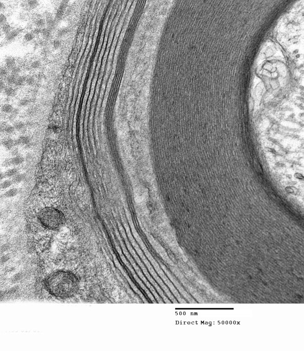 6B1C Anti-MAG (Case 6) EM019 - Copy