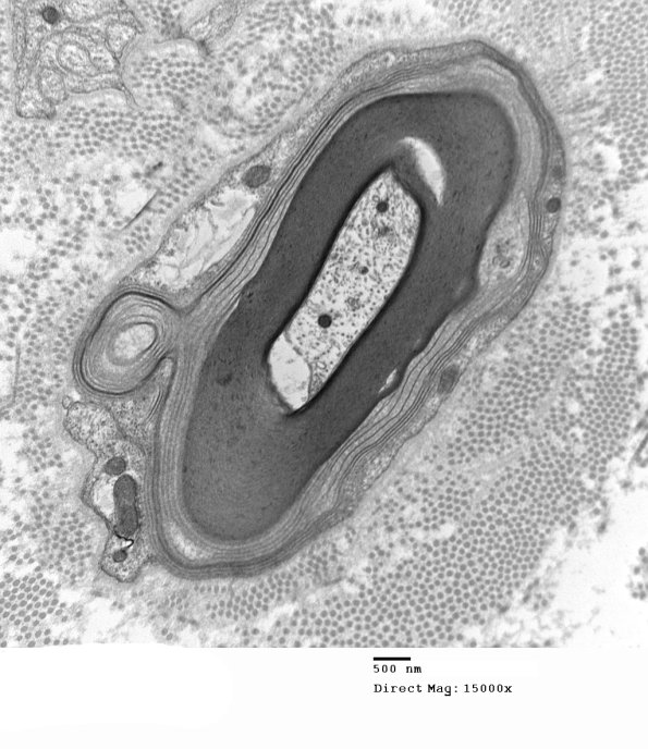 6B2A Anti-MAG NP (Case 6) EM 023 - Copy