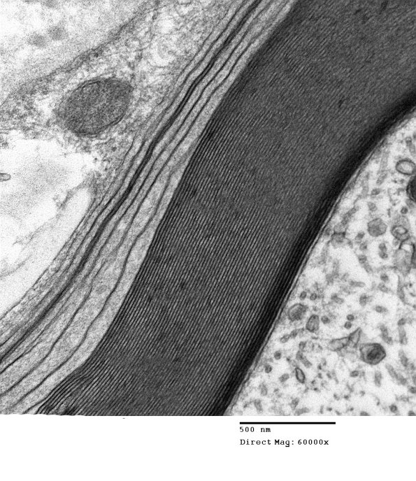 6B2B Anti-MAG NP (Case 6) EM 026A - Copy
