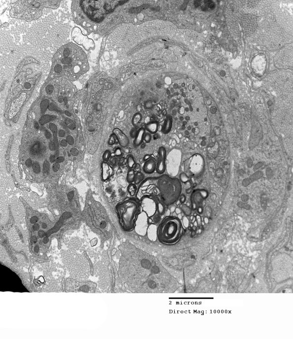6C1A Anti-MAG NP (Case 6) EM 040 - Copy