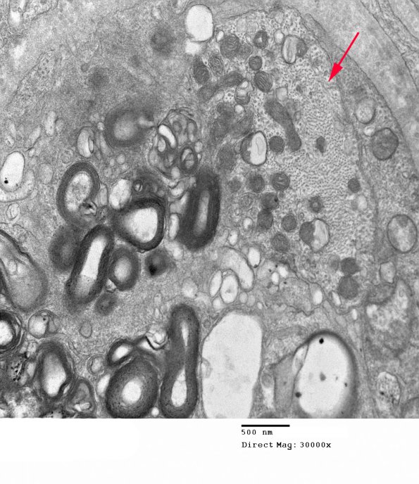 6C1B Anti-MAG NP (Case 6) EM 043 - Copy copy