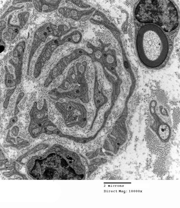 6C2A Anti-MAG NP (Case 6) EM 004 - Copy