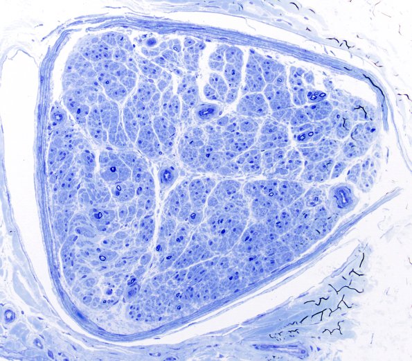 7B1 Anti-MAG (Case 7) Plastic 20X 1