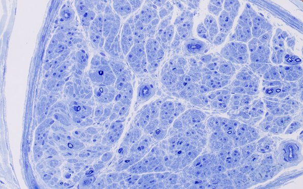 7B2 Anti-MAG (Case 7) Plastic 40X 1