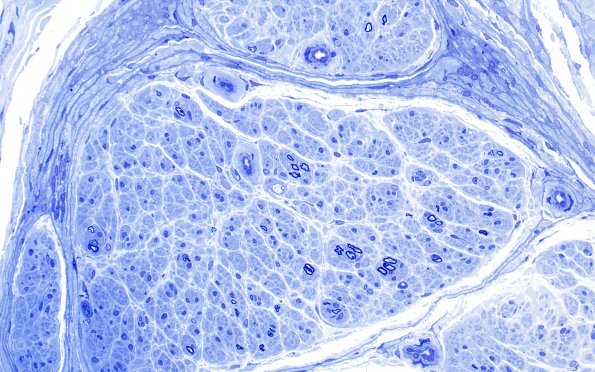 7B4 Anti-MAG (Case 7) Plastic 40X 2