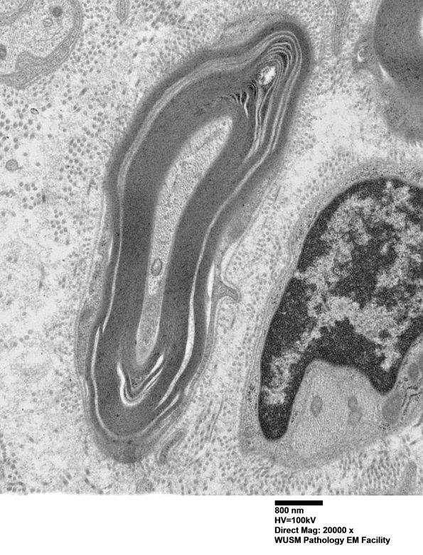 7C1A Anti-MAG (Case 7) sural_007 - Copy