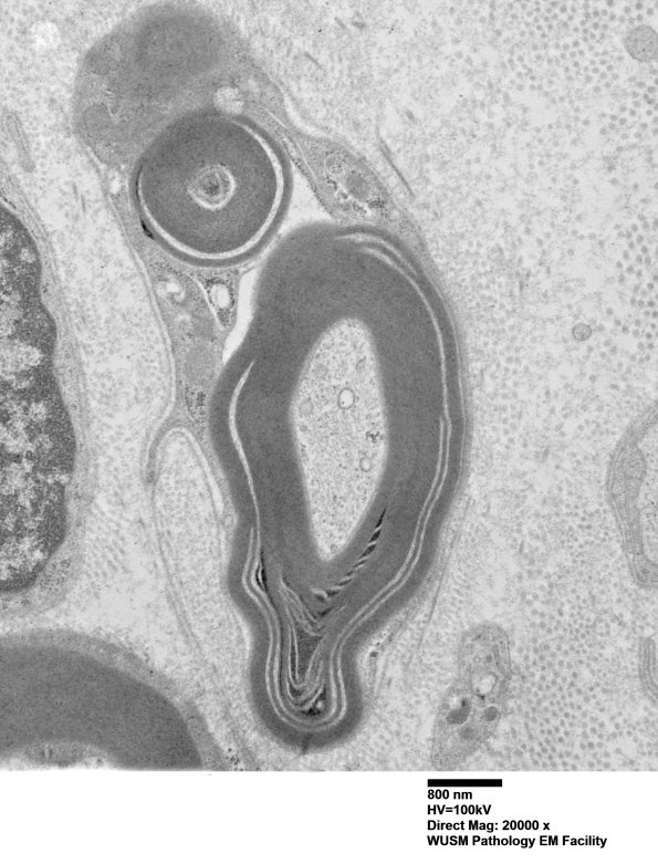 7C2A Anti-MAG (Case 7) nerve_070 - Copy