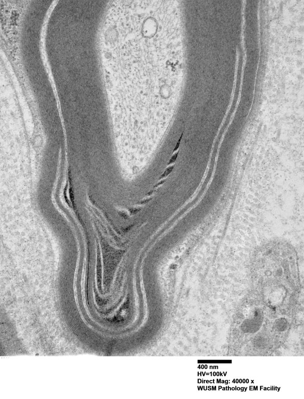 7C2B Anti-MAG (Case 7) nerve_071 - Copy