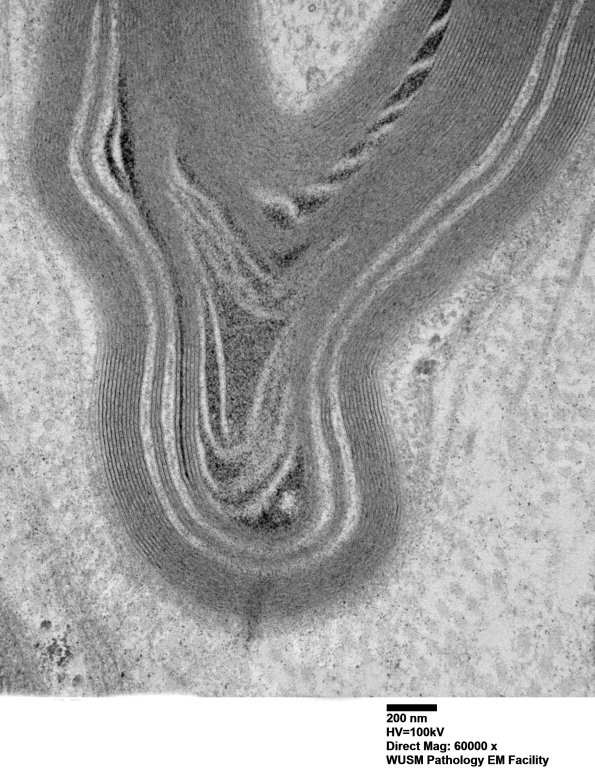 7C2C Anti-MAG (Case 7) nerve_072 - Copy