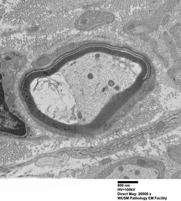 7C3A Anti-MAG (Case 7) sural_002 - Copy