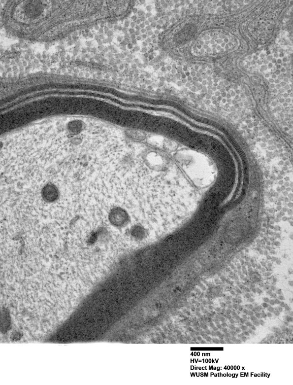 7C3B Anti-MAG (Case 7) sural_003 - Copy