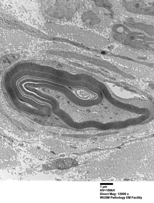 7C4A Anti-MAG (Case 7) sural_004 - Copy