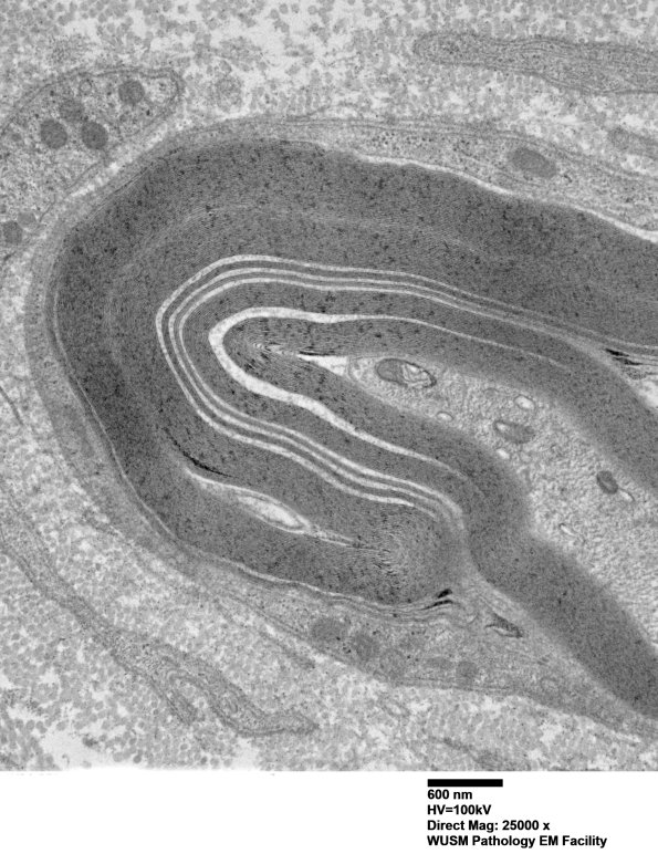 7C4B Anti-MAG (Case 7) sural_005 - Copy