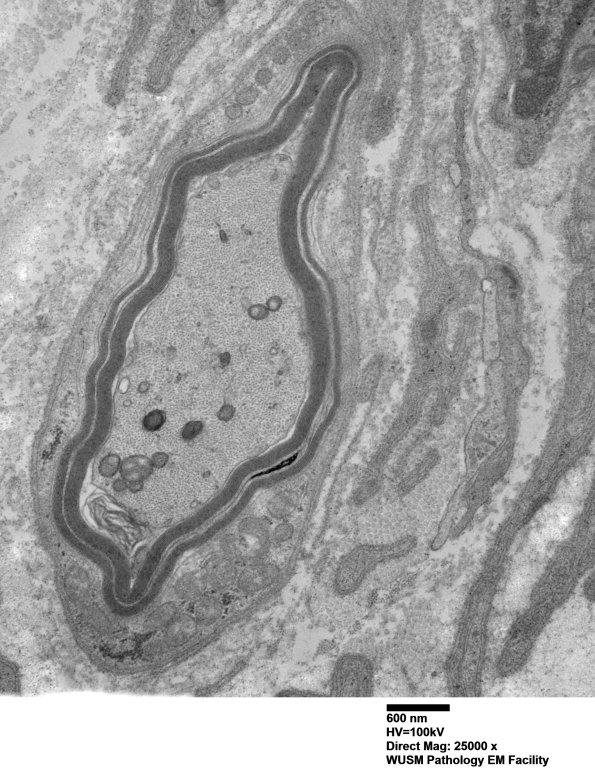 7C5A Anti-MAG (Case 7) 006 - Copy