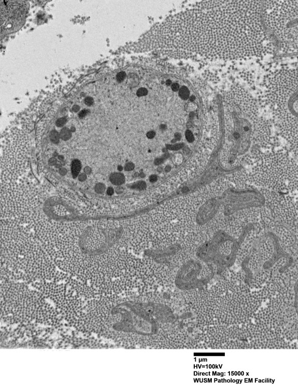 7D Anti-MAG (Case 7) sural_001 - Copy