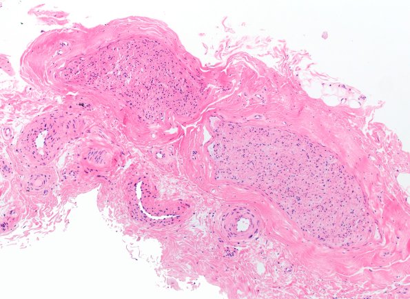 9A1 WSM (Case 9) H&E 10X 1