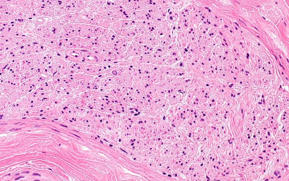 9A2 (Case 9) H&E 40X 2