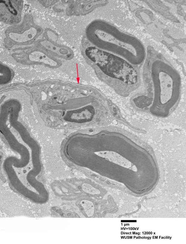 9C2A (Case 9) Nerve_025 - Copy copy