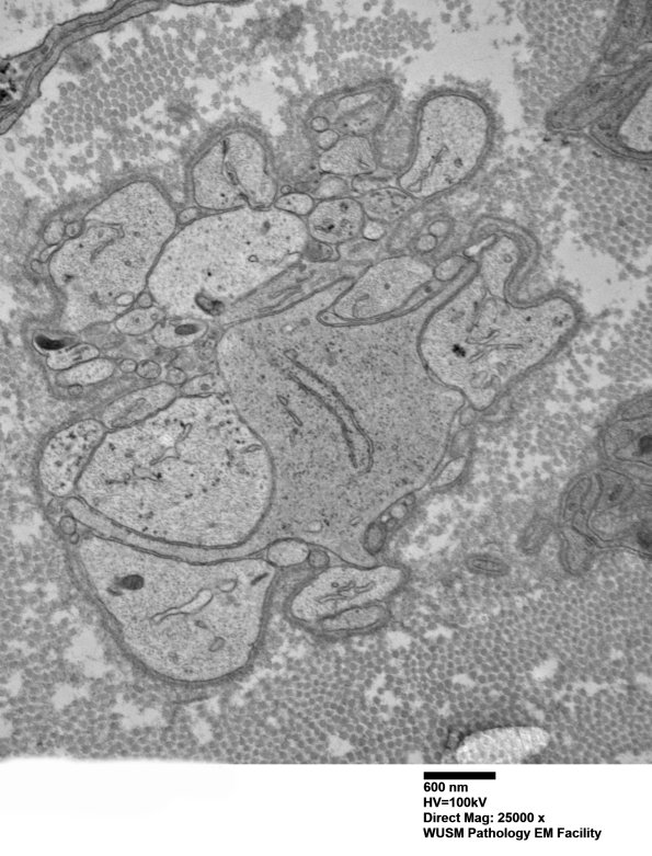 9D1 (Case 9) Nerve_030 - Copy