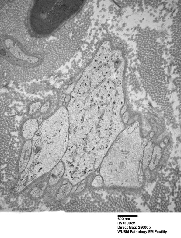 9D2 (Case 9) Nerve_005 - Copy