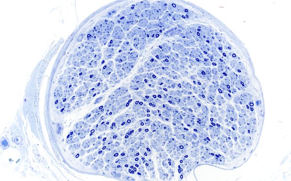 1A1 POEMS (Case 1) Plastic 20X 2