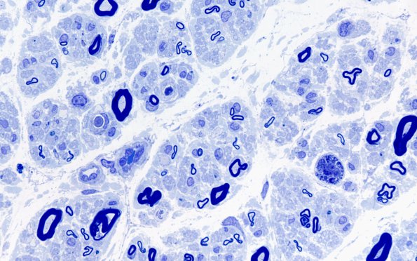 1A2 POEMS (Case 1) Plastic 100X 9