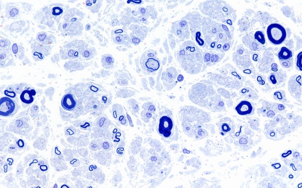 1A3 POEMS (Case 1) Plastic B 100X 2