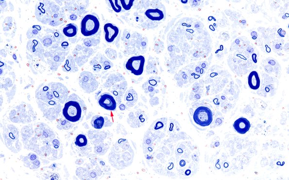 1A4 POEMS (Case 1) Plastic B 100X 4 copy