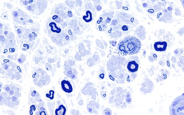 1A5 POEMS (Case 1) Plastic B 100X 11