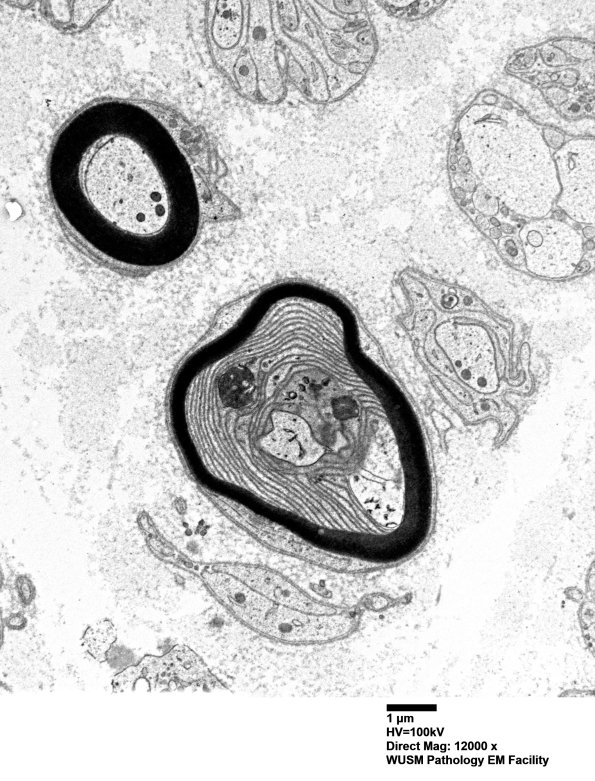 1B1A (Case 1) Sural_066 - Copy