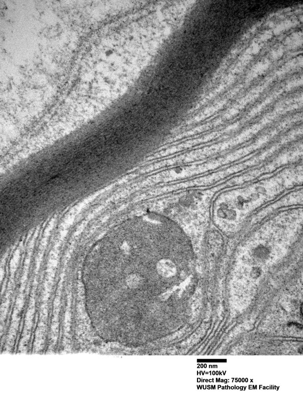 1B1D (Case 1) Sural_074 - Copy