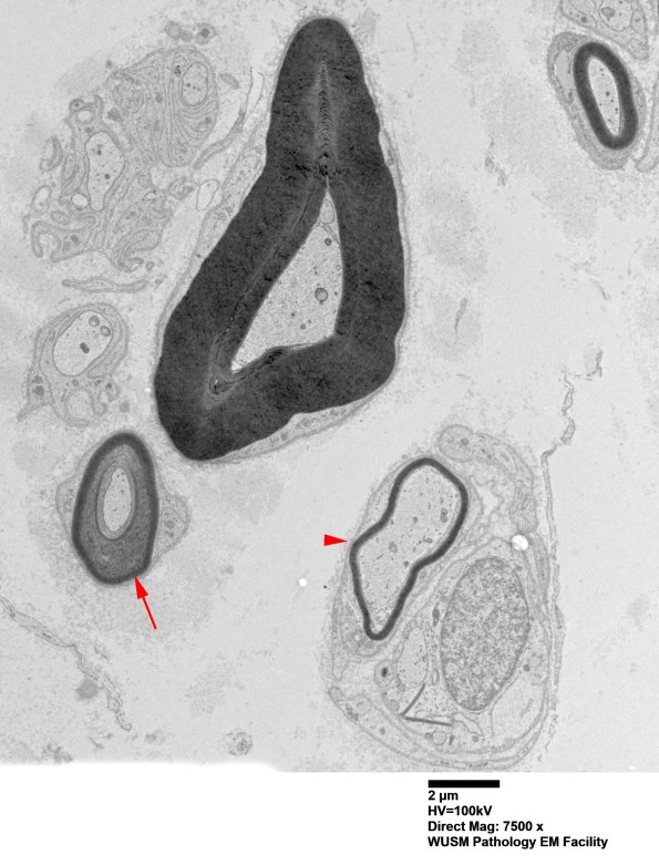 1B2A (Case 1) Sural_034 copy - Copy