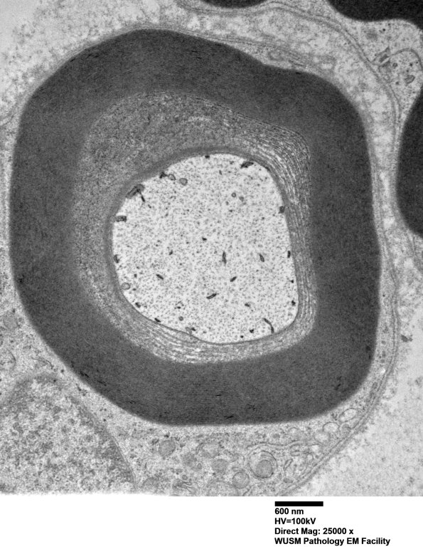 1B3B (Case 1) Sural_060 - Copy