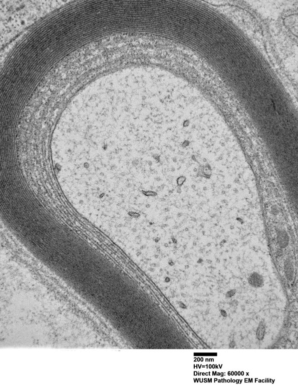 1B4B (Case 1) Sural_025 - Copy